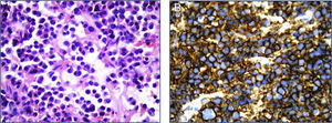 A: Pancreatic biopsy showing neoplastic plasma cell infiltration (H/E×100). B: Immunohistochemistry showing CD138 expression.