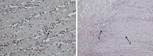 Izquierda: grupo de eosinófilos (flecha 1) infiltrando las capas del intestino delgado (>40 eosinófilos/campo). Derecha: eosinófilos que infiltran capa muscular (flecha 2) y llegan hasta la capa subserosa (flecha 3) del intestino delgado.