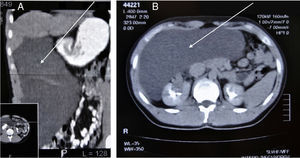 En la imagen TC se observa una gran lesión quística que desplaza el resto de estructuras intraabdominales.