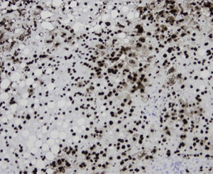 Inmunotinción de una sección de hígado con anticuerpos anti-VHS1: se aprecia positividad nuclear en la mayoría de los hepatocitos (inmunoperoxidasa, aumento original x100).