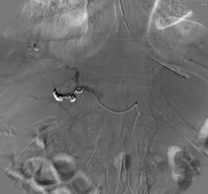 Rama de la arteria hepática derecha con seudoaneurisma embolizada mediante microcoils de platino.
