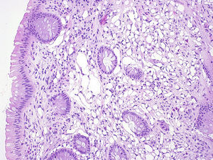 Se aprecian espacios vacíos entre los fibroblastos normales que disecan las glándulas de la lámina propia y recuerdan a los adipocitos (Hematoxilina-Eosina 20×).