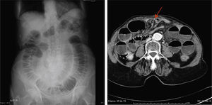 a) Radiología simple de abdomen: dilatación de las asas de intestino delgado con una llamativa disposición «en espiral». b) TC abdominal: imagen «en remolino» correspondiente a la torsión de los vasos mesentéricos (flecha roja).