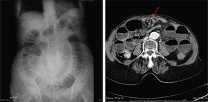 a) Radiología simple de abdomen: dilatación de las asas de intestino delgado con una llamativa disposición «en espiral». b) TC abdominal: imagen «en remolino» correspondiente a la torsión de los vasos mesentéricos (flecha roja).