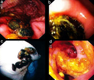 Upper gastrointestinal endoscopy showing gallstones in the gastric corpus (image a) and an impacted gallstone at pylorus (image b). Retrieved gallstones after mechanical lithotripsy with snare and Dormia basket (image c). Endoscopic view of the duodenal bulb: fistulous stoma with surrounding duodenal bulb mucosa extensively ulcerated (image d).
