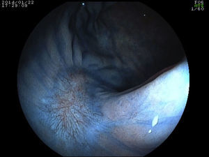 Cromoendoscopia con índigo carmín sobre la cicatriz en la zona de DSE a los 6 meses del procedimiento.
