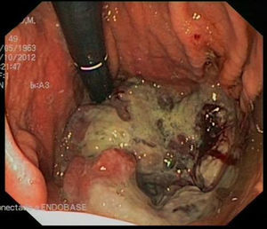 Endoscopia digestiva alta. Neoformación a nivel de cuerpo gástrico y fundus.