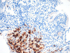 Se observa fuerte tinción citoplasmática para HMB-45 de las células neoplásicas. Inmunohistoquímica, tinción HMB-45 (200×).