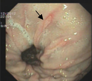 Úlceras lineales fibrinoides en saco herniario (úlceras de Cameron).