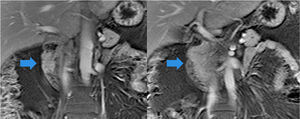 Imágenes coronales potenciadas T1 con saturación grasa y contraste (gadolinio) en las que se pone en evidencia el tejido pancreático a ambos lados de la luz duodenal.