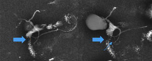 Colangiografía en la que se aprecia la impronta que produce el páncreas en la pared lateral del duodeno (flecha gruesa), un conducto de Santorini persistente y un bucle en la porción ventral, se visualiza con dificultad el conducto anular (flecha fina).