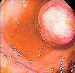 Enteroscopia de doble balón. Pólipo fibroso inflamatorio.