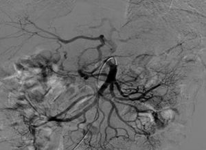 Inyección selectiva de contraste de la arteria mesentérica superior con visualización de la arcada gastroduodenal.
