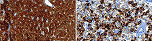 a) Masa tumoral que infiltra el epitelio duodenal causando sangrando circundante. b) y c) Tumor neuroendocrino positivo para las tinciones con sinaptofisina y cromogranina respectivamente.