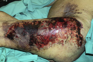 Lesiones purpúricas de aspecto livedoide con áreas extensas de ulceración y escarificación en muslos.