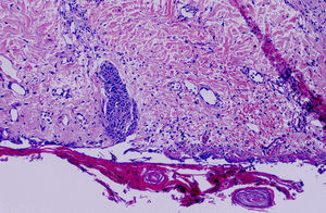 Necrosis cutánea superficial con extravasación de hematíes en dermis superficial y neogénesis vascular dérmica (hematoxilina y eosina, x40).