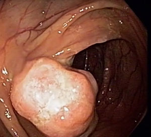 Imagen colonoscópica de la tumoración.