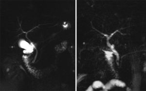 PA con coledocolitiasis (colédoco intrapancreático).