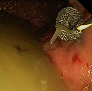 Necrosectomía endoscópica guiada por USE. Extremo proximal de la prótesis metálica totalmente cubierta específica para drenajes transmurales (10mm; AXIOS™, Xlumena) con cavidad gástrica conteniendo líquido denso.