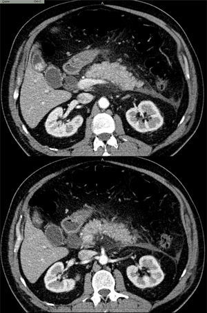 PA edematosa intersticial.