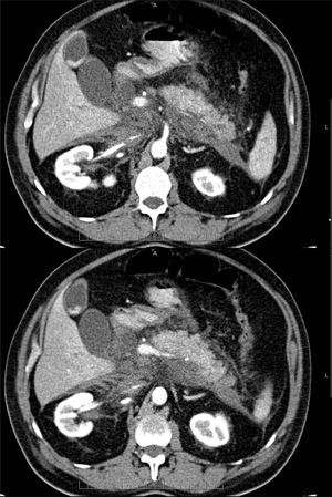 Edematosa intersticial con CALP.