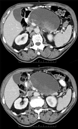 Necrosis encapsulada.