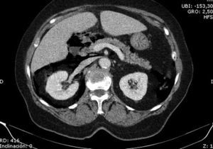 Imagen de TC abdominal tras la realización de la CPRE en la que se observa retroneumoperitoneo y neumoperitoneo importante.