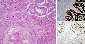 En la imagen de la izquierda (hematoxilina-eosina) se reconocen los 2 componentes de la neoplasia, en la parte inferior el carcinoma epidermoide y en la superior el adenocarcinoma. Por técnica de inmunohistoquímica se identifica el componente glandular, citoqueratina 20 positivo (foto derecha-superior) y el componente escamoso, p63 positivo (foto derecha-inferior).