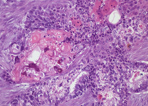 Metástasis hepática, en la que se reconocen los 2 componentes (adenocarcinoma y carcinoma epidermoide) del carcinoma adenoescamoso de intestino grueso (hematoxilina eosina).