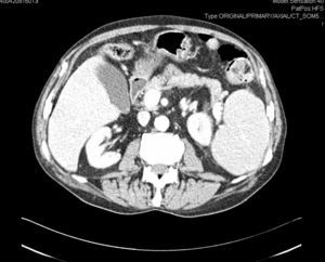 Imagen de TAC con neumatosis en el ángulo esplénico del colon y presencia de aire extraluminal.