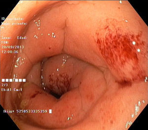 Imagen tomada en la colonoscopia, a 12cm de margen anal, en la que se observa mucosa de aspecto edematoso con hemorragia submucosa con distribución parcheada.