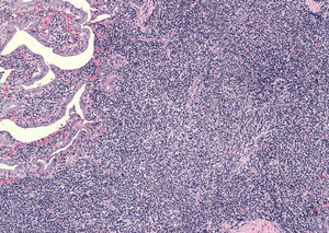 Hematoxilina-eosina (400x): mucosa y pared de vesícula biliar con denso infiltrado inflamatorio linfocitario.