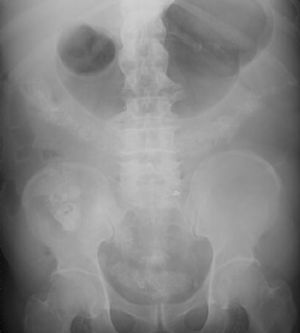 Radiografía de abdomen. Imagen sospechosa de contraste baritado en tubo digestivo.