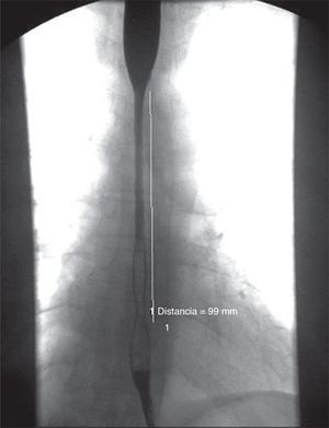 Esofagograma. Estenosis esofágica de 10cm aproximadamente, uniforme, con buen paso del contraste.