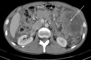 Imagen de TC abdominal en la que se observa gran tumoración localizada en hipocondrio izquierdo y líquido ascítico.