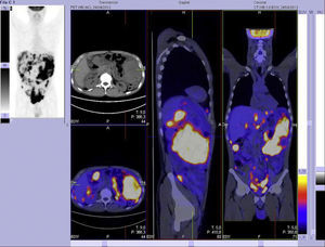Imagen de la PET, en el que se observa la presencia de gran masa hipermetabólica en hipocondrio izquierdo, junto a múltiples focos de menor tamaño distribuidos en toda la cavidad abdominal.