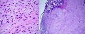 Tinción con hematoxilina-eosina: microscópicamente se observan proliferación de células fusifomes, con baja densidad celular, con núcleos ovales e hipercromáticos, con ligero pleomorfismo, cromatina finamente agrupada y uno o varios nucléolos pequeños, con escasa actividad mitótica (5 mitosis-50 CGA). Células depositadas en estroma mixoide, que varía en la tumoración, con transición entre ellas. En las zonas de mayor densidad infiltrado inflamatorio linfoplasmocitario. Depósitos de hemosiderina.