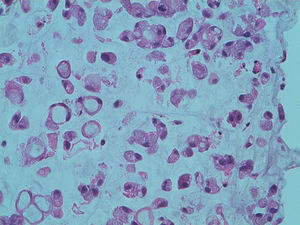 Carcinoma de células en anillo de sello (tinción H&E).