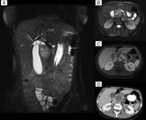Técnicas de imagen: a y b) La RM muestra los planos coronal y axial de la lesión tomados en secuencia T2-FS-HASTE. c) La RM pertenece a la fase dinámica tras la inyección de contraste intravenoso para el estudio parenquimatoso. d) Tomada del TC, descarta absceso.
