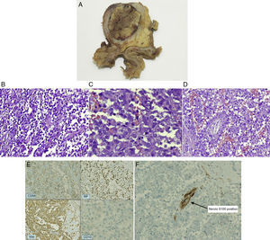 Estudio anatomopatológico de la muestra: a) En el estudio macroscópico se observa una lesión bien delimitada y rodeada por una gruesa cápsula de aspecto fibroso. Presenta en la periferia coloración grisácea y consistencia elástica mientras que en el centro muestra coloración pardo-rojiza y aspecto necrótico-hemorrágico. b) El estudio histológico muestra una lesión con patrón de crecimiento seudopapilar constituida por grupos de células epiteliales mezcladas con capilares de paredes finas. c) Las células tumorales muestran citoplasmas eosinófilos y núcleos uniformes, redondeados u ovalados con cromatina finamente granular, nucléolos de pequeño tamaño y alguna hendidura ocasional. No se observa pleomorfismo nuclear ni mitosis. d) En la presente imagen se observan signos de infiltración perineural. e) El estudio inmunohistológico muestra positividad para receptores de progesterona (RP), vimentina (Vim) intensamente positivos, CD56: positivo y CD10: focalmente positivo. f) Con técnica de inmunohistoquímica se observa el nervio, que es proteína S100 positivo, rodeado por células tumorales.