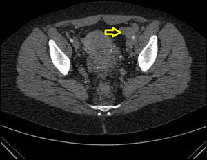 Conglomerado de formaciones vasculares venosas alrededor de la arteria iliaca izquierda (punto blanco en el centro) en la región pélvica izquierda principalmente, que podría corresponderse a las zonas adyacentes al colon sigmoides, el segmento objetivado en la endoscopia.