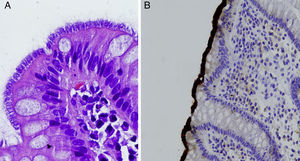 Biopsia de colon. A) Se objetiva una banda filamentosa en la superficie del epitelio colónico, sugestiva de espiroquetosis (H-E). B) La tinción positiva con anticuerpos antitreponema permite una mejor visualización de los microorganismos en el polo luminal de las células del epitelio superficial.