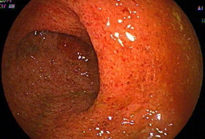 Mucosa rectal eritematosa y congestiva con erosiones superficiales fibrinadas.