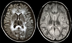 Imagen de RMN en la que se observan datos de leucoencefalopatía metacromática con extensa afectación cerebral subcortical, de centros semiovales, de cápsulas internas y externas y ambos branchium pontis.