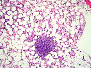 Médula ósea hipocelular que presenta áreas de severa hipoplasia en 4/5 partes del cilindro.