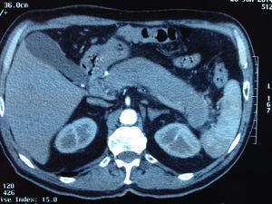RM con aumento difuso de la glándula pancreática.