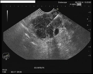 PAAF guiada por ecoendoscopia de masa pancreática.