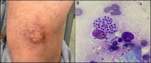 A) Aspecto de la lesión antes del tratamiento. B) Histiocito con Leishmanias (flecha) en el interior de su citoplasma (Giemsa ×250).