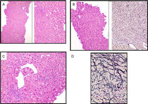 Alteraciones histológicas en la hipertensión portal idiopática no cirrótica. (A) Dilatación sinusoidal. (B) Hiperplasia nodular regenerativa. (C) Vasos aberrantes paraportales. (D) Fibrosis perisinusoidal. Fotos cedidas por la Dra. Alba Díaz.