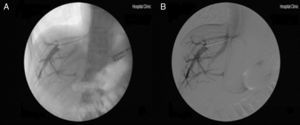 Hemodinámica hepática en paciente con diagnóstico de hipertensión portal idiopática no cirrótica. (A) Presencia de colaterales vena-vena intrahepáticas. (B) Venografía en modo de substracción evidenciando las colaterales.
